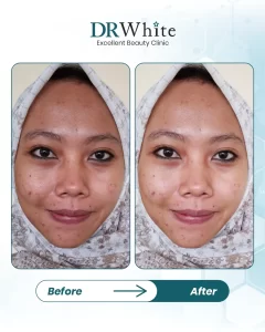 5 LANDING PAGE DUAL GLOWING LASER_11zon