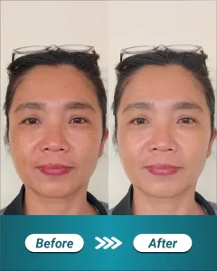 1 BEFORE AFTER LANDING PAGE IPL GLOW_11zon