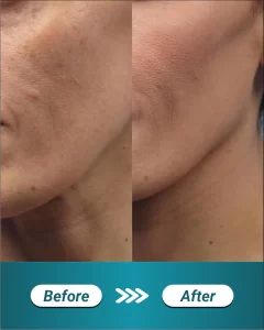 1 LP LASER FRACTIONAL CO2 (BEFORE AFTER)_11zon