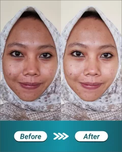 2 BEFORE AFTER LANDING PAGE IPL GLOW_11zon