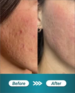 2 LP LASER FRACTIONAL CO2 (BEFORE AFTER)_11zon