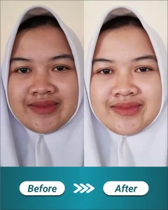 4 BEFORE AFTER LANDING PAGE IPL GLOW_11zon