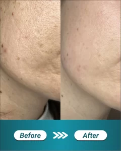 5 LP LASER FRACTIONAL CO2 (BEFORE AFTER)_11zon