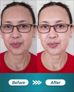 6 BEFORE AFTER LANDING PAGE IPL GLOW_11zon